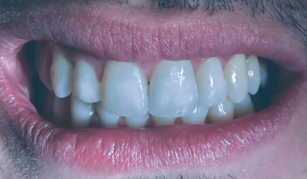 Aligners result after treatment